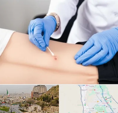 متخصص زخم بستر در فرهنگ شهر شیراز 