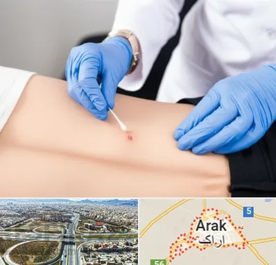 متخصص زخم بستر در اراک