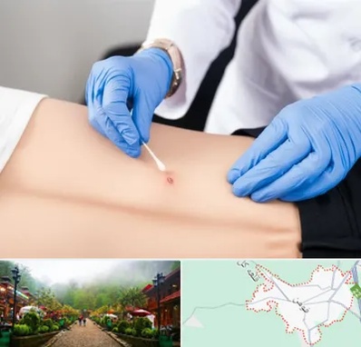 متخصص زخم بستر در فومن