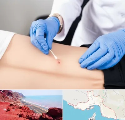 متخصص زخم بستر در هرمزگان