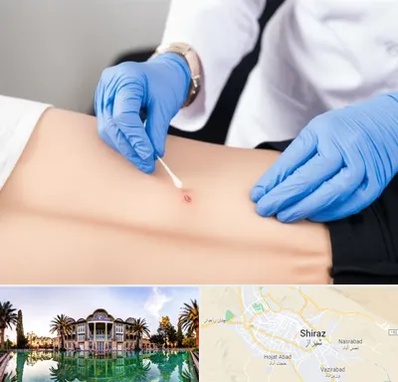 متخصص زخم بستر در شیراز