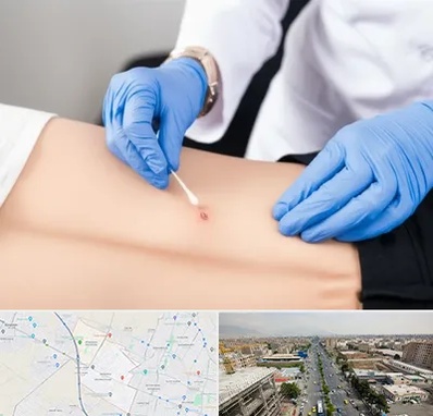 متخصص زخم بستر در حصارک کرج 