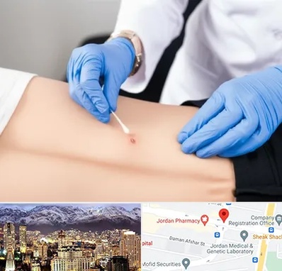 متخصص زخم بستر در جردن 