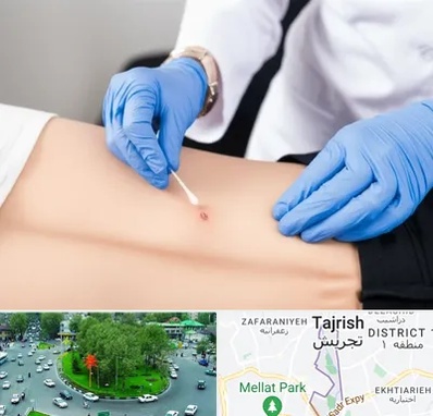 متخصص زخم بستر در تجریش 