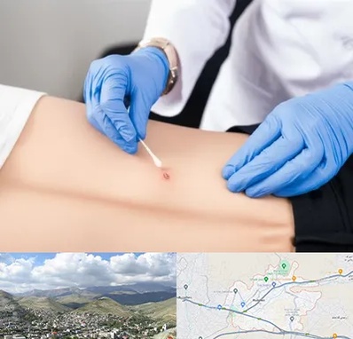 متخصص زخم بستر در رودهن