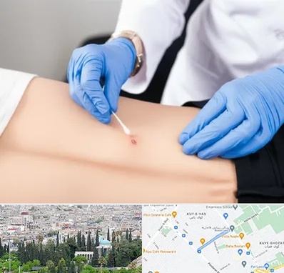 متخصص زخم بستر در محلاتی شیراز 