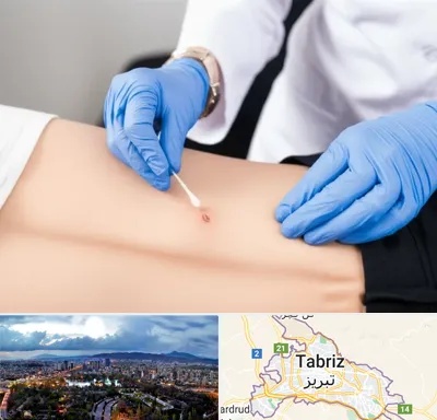 متخصص زخم بستر در تبریز