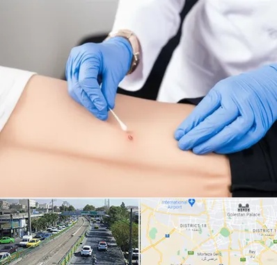 متخصص زخم بستر در جنوب تهران 