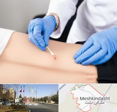 متخصص زخم بستر در مشکین دشت