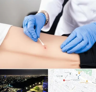 متخصص زخم بستر در هفت تیر مشهد 