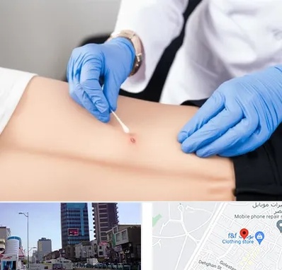 متخصص زخم بستر در چهارراه طالقانی کرج 