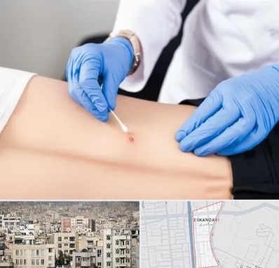 متخصص زخم بستر در اسکندری