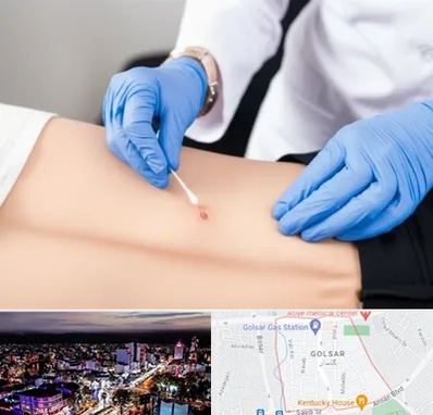 متخصص زخم بستر در گلسار رشت 