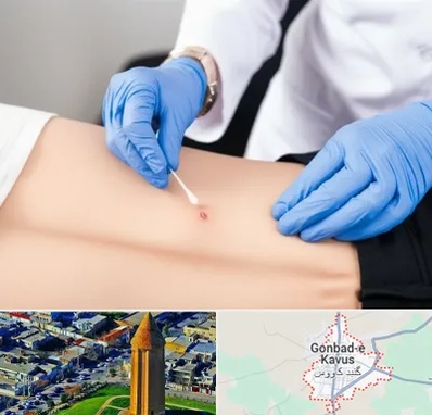 متخصص زخم بستر در گنبد کاووس