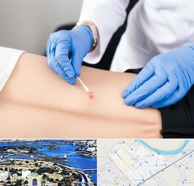 متخصص زخم بستر در کوروش اهواز 