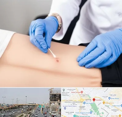 متخصص زخم بستر در بلوار توس مشهد 