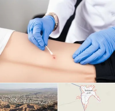 متخصص زخم بستر در اسفراین