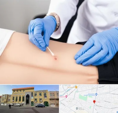 متخصص زخم بستر در زنبیل آباد قم 