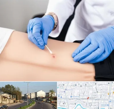 متخصص زخم بستر در ضیابری رشت 