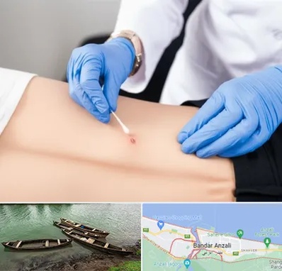 متخصص زخم بستر در بندر انزلی