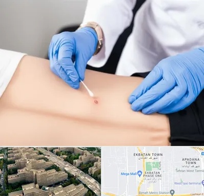 متخصص زخم بستر در اکباتان 