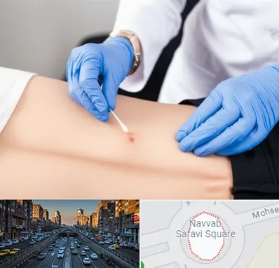 متخصص زخم بستر در نواب 