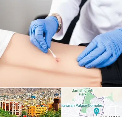 متخصص زخم بستر در نیاوران 