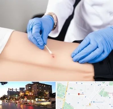 متخصص زخم بستر در بلوار سجاد مشهد 