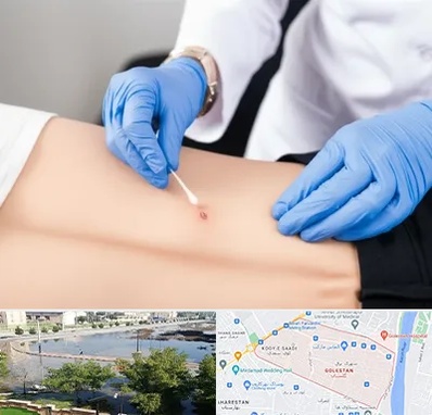 متخصص زخم بستر در گلستان اهواز 