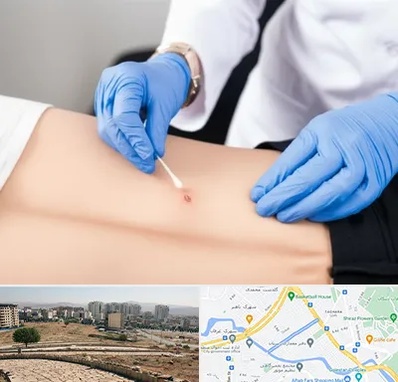 متخصص زخم بستر در کوی وحدت شیراز 