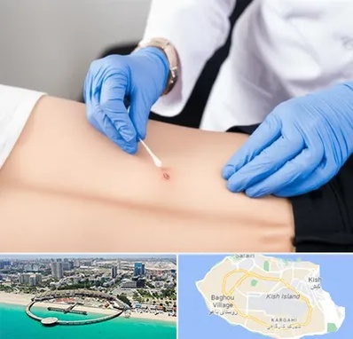 متخصص زخم بستر در کیش