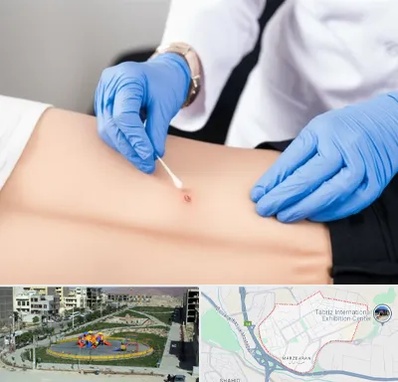 متخصص زخم بستر در مرزداران تبریز 