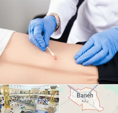 متخصص زخم بستر در بانه