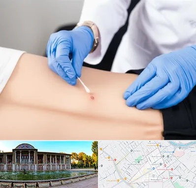 متخصص زخم بستر در عفیف آباد شیراز 