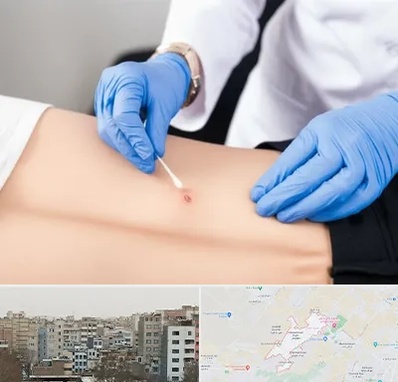 متخصص زخم بستر در محمد شهر کرج 