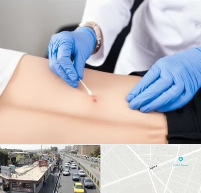 متخصص زخم بستر در خیابان دماوند