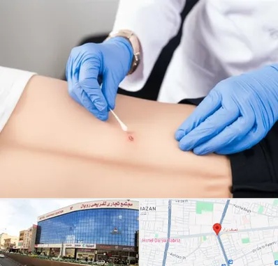 متخصص زخم بستر در نصف راه تبریز 