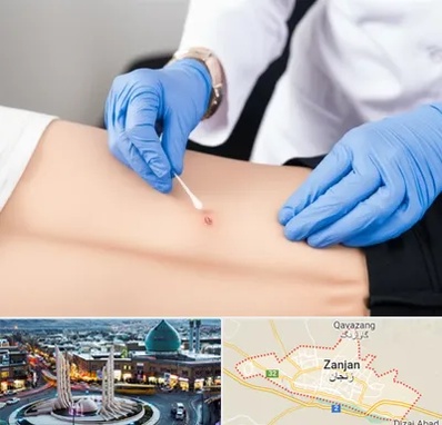 متخصص زخم بستر در زنجان