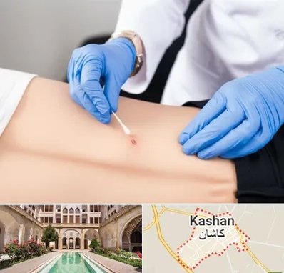 متخصص زخم بستر در کاشان
