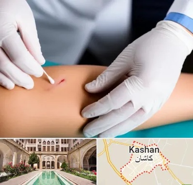 متخصص زخم عفونی در کاشان