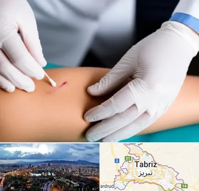 متخصص زخم عفونی در تبریز