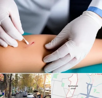متخصص زخم عفونی در کاشانک