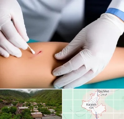 متخصص زخم عفونی در کلاله