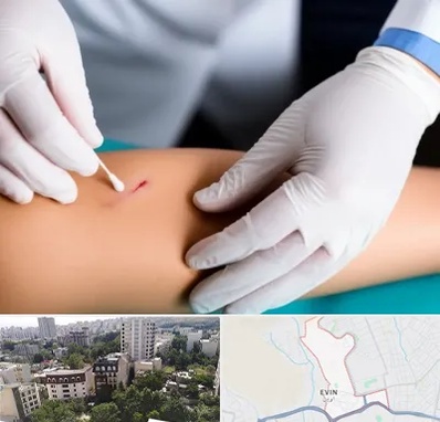 متخصص زخم عفونی در اوین 