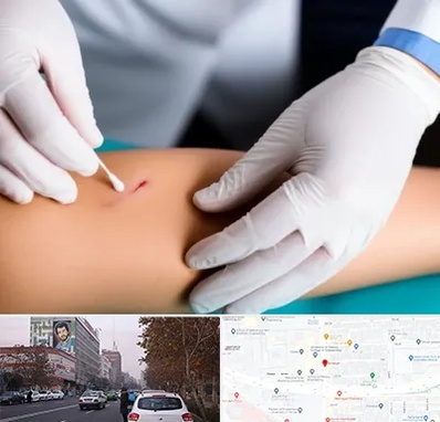 متخصص زخم عفونی در کارگر شمالی 