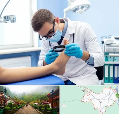 درمان زخم پای دیابتی در فومن