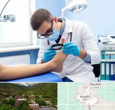 درمان زخم پای دیابتی در کلاله