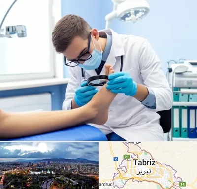 درمان زخم پای دیابتی در تبریز