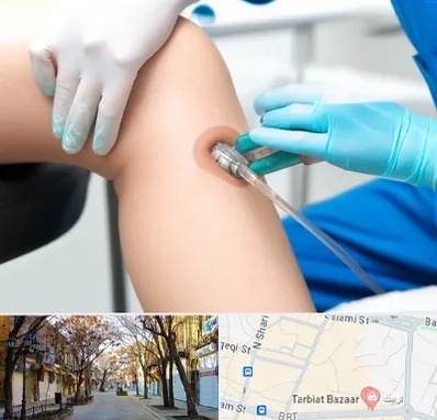 اوزون تراپی در تربیت تبریز 