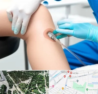 اوزون تراپی در سالاریه قم